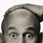 hair loss bald